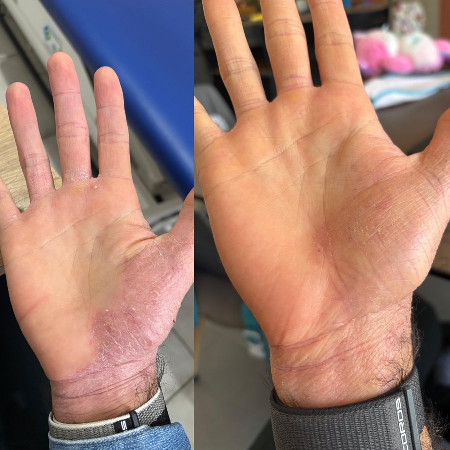 Clément, sa main avant et après