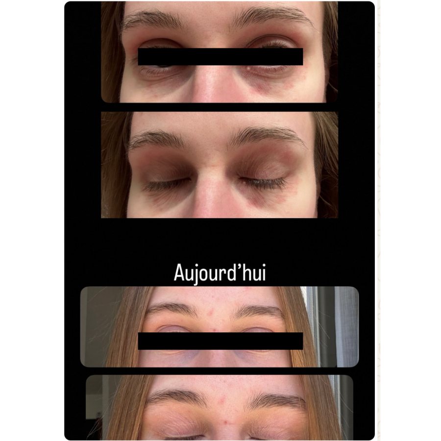 Mathilde, les paupières avant et après